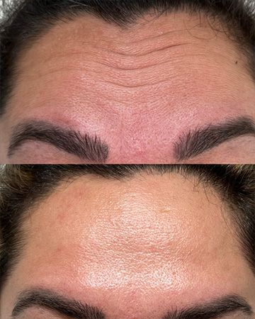 derrmal fillers treatments