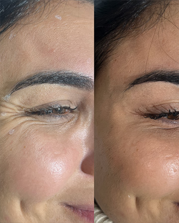 Anti wrinkle treatments