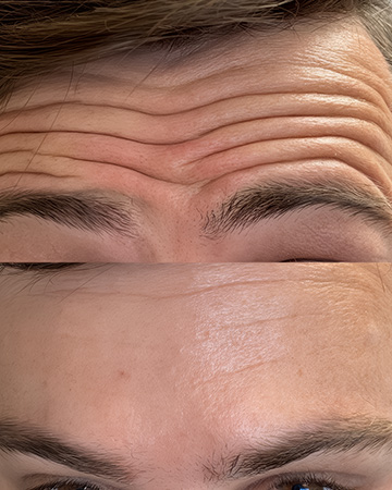 Anti wrinkle treatments