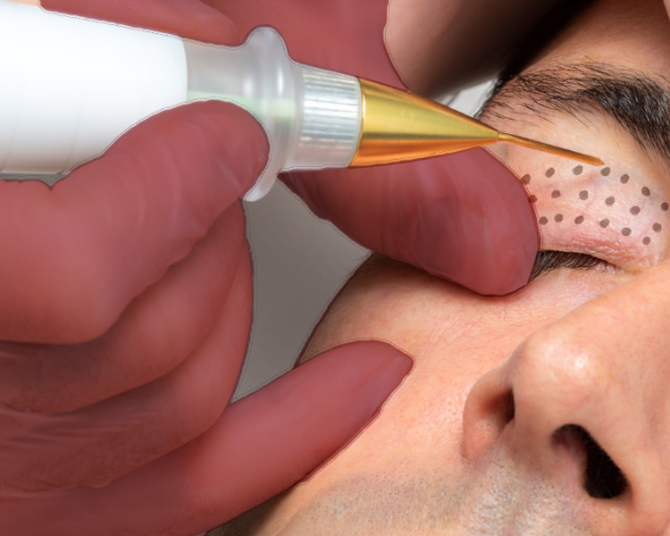 Fibroblast Skin Tightening