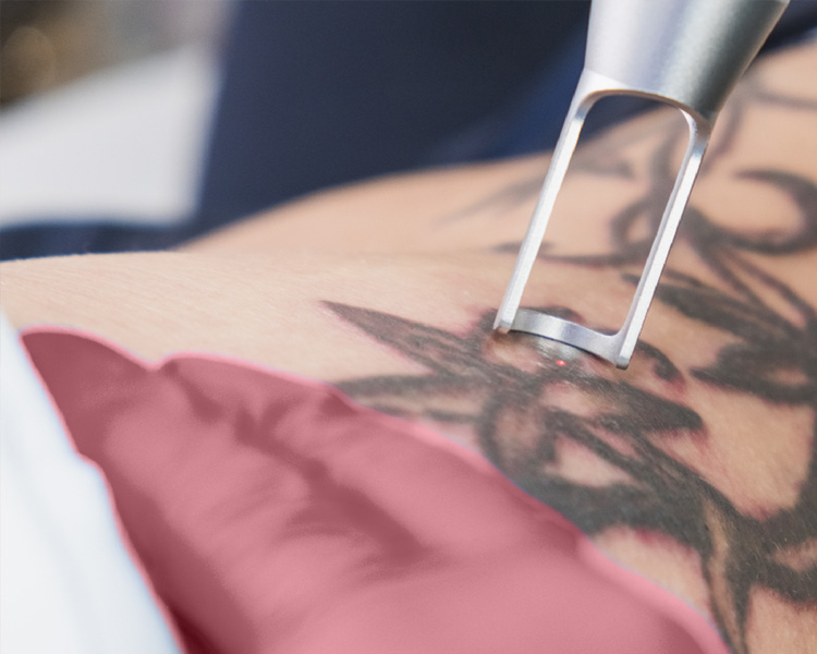 laser-tattoo-removal